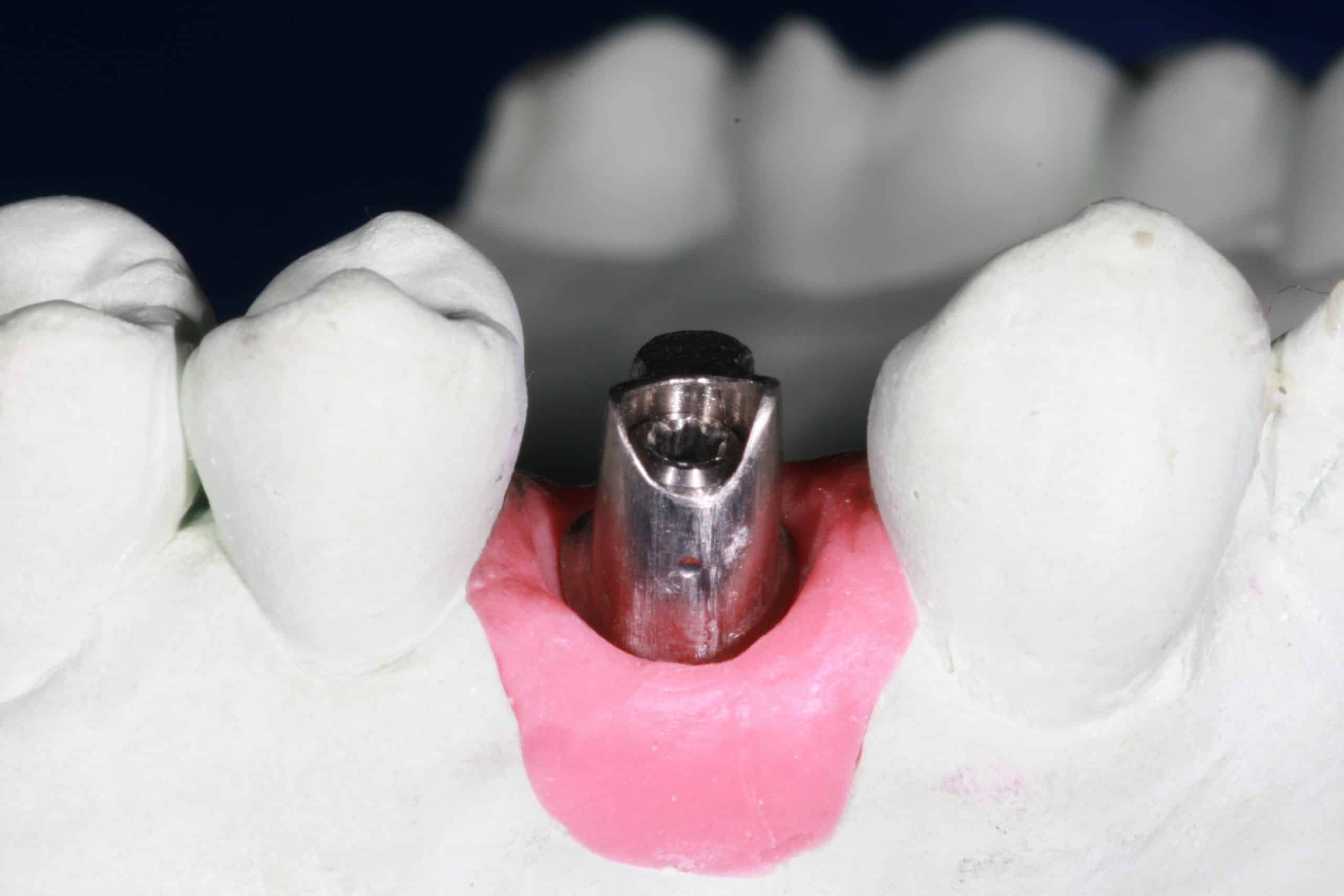 Abutment and Crown (Cap) Advanced Dentistry & Dental Implant Center