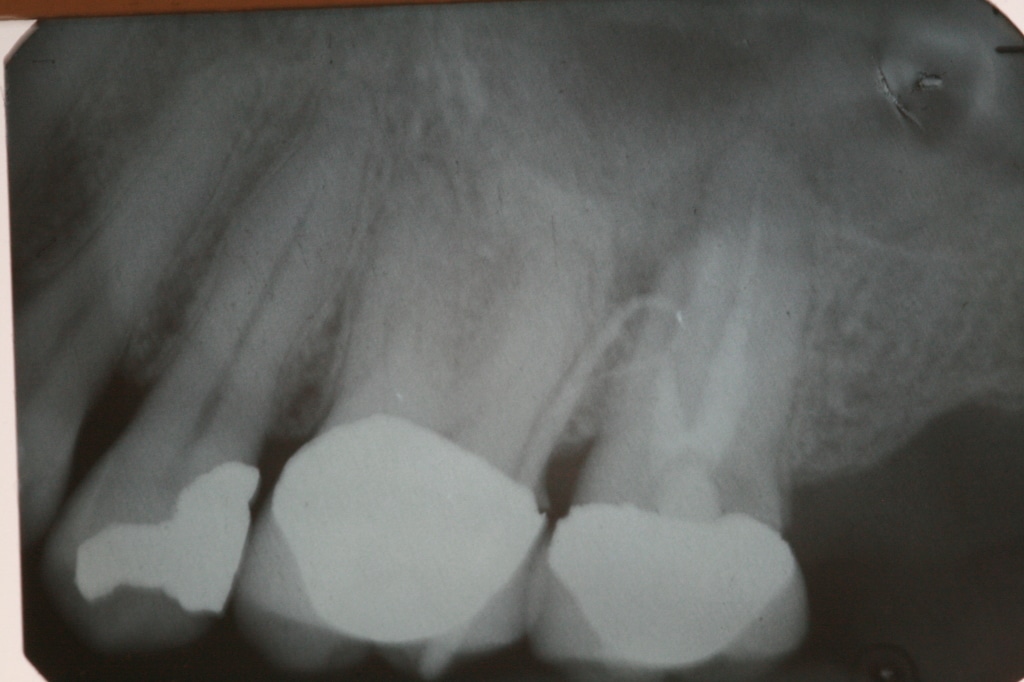 Oral Fistula Traced Advanced Dentistry & Dental Implant Center