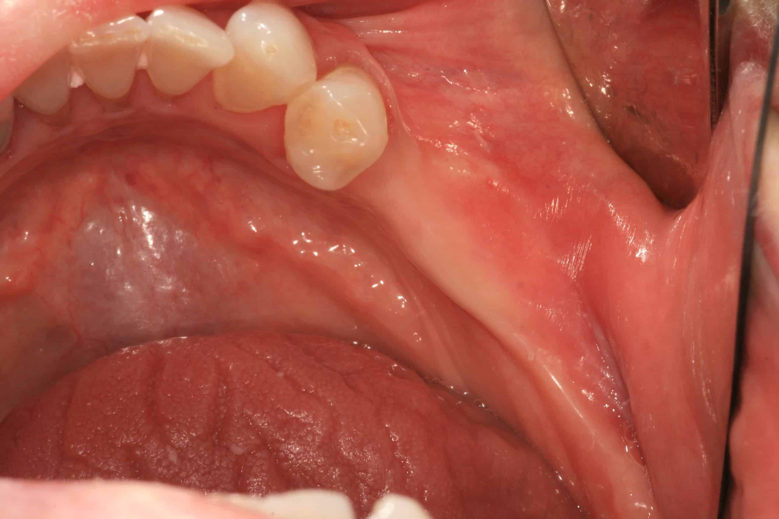 Implants Placed After Tunnel Graft Healed Advanced Dentistry & Dental