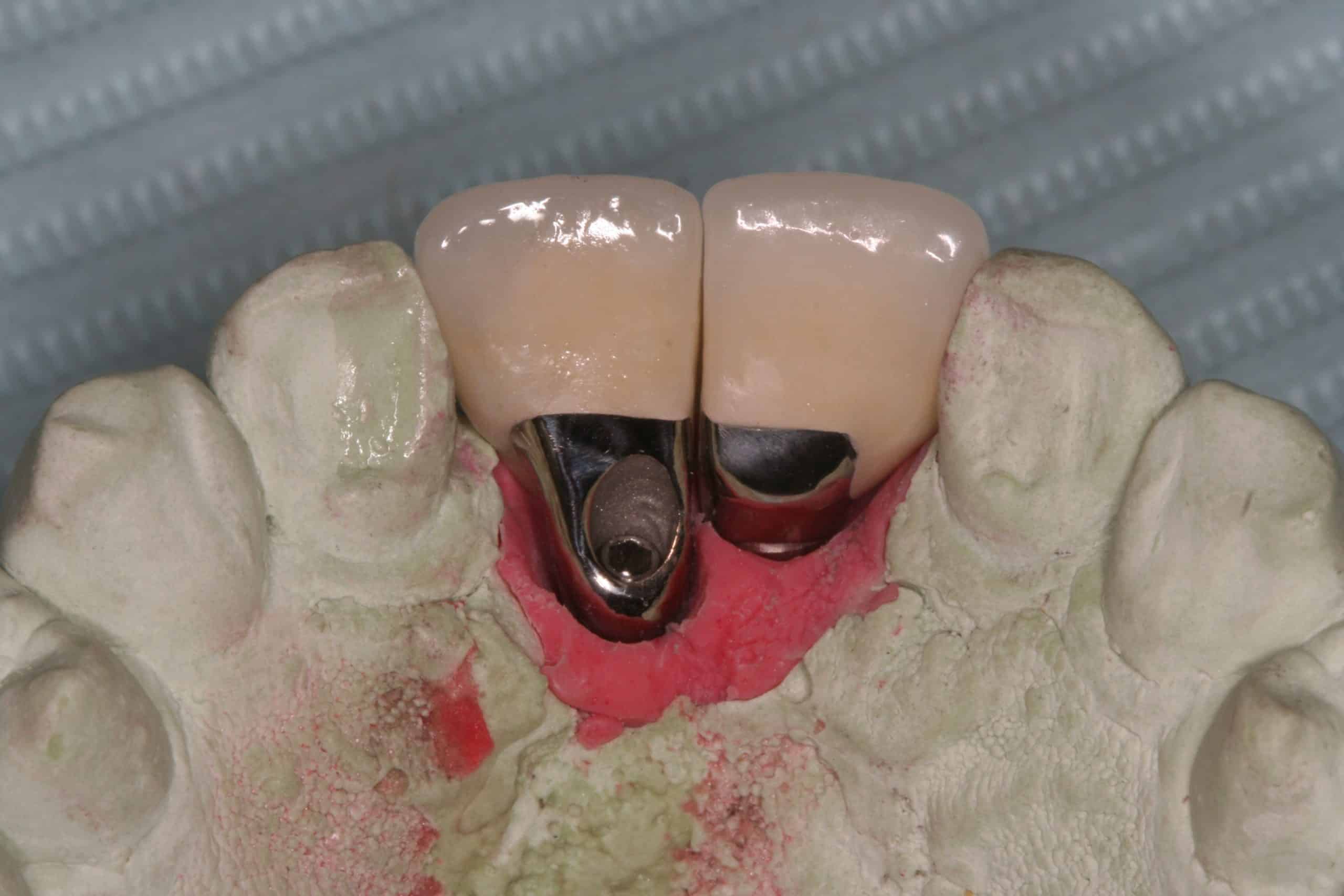 Poor Implant Positioning (not my case) Advanced Dentistry & Dental