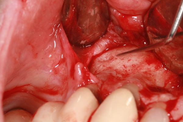 Oral Surgery | Advanced Dentistry & Dental Implant Center