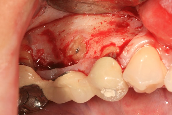 Dental Disease | Advanced Dentistry & Dental Implant Center