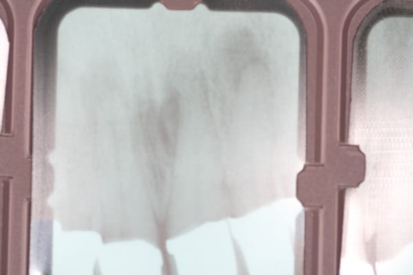 Fistula | Oral Surgery | Advanced Dentistry & Dental Implant Center