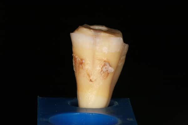 Root Fracture | Advanced Dentistry & Dental Implant Center