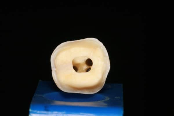 Root Fracture | Advanced Dentistry & Dental Implant Center