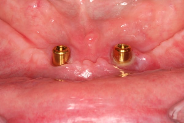 implant overdenture