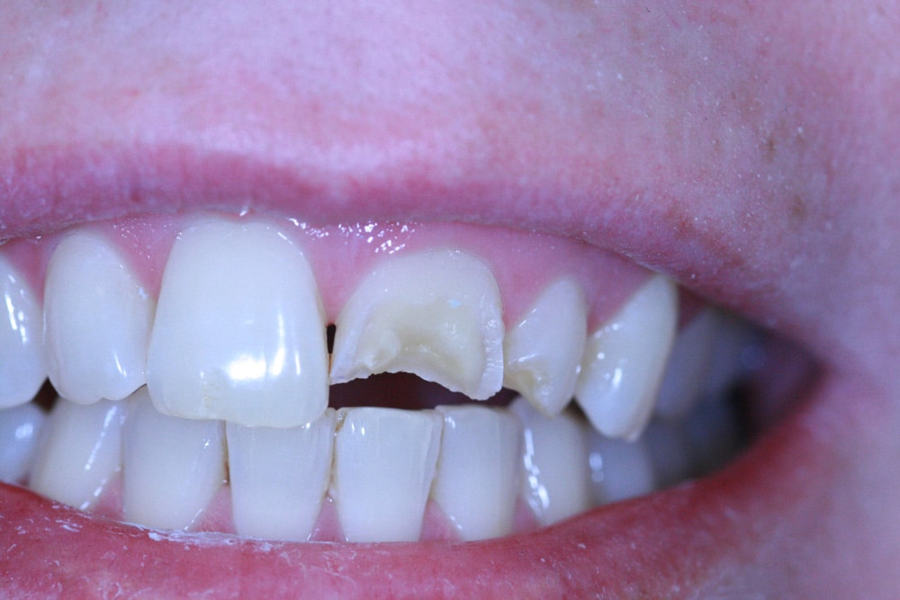 Dental Crown | Advanced Dentistry & Dental Implant Center