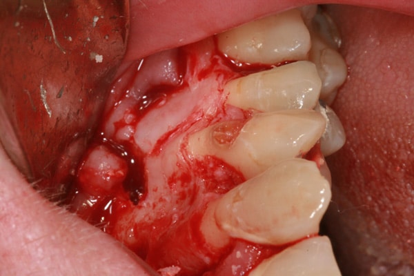 oral surgery | Advanced Dentistry & Dental Implant Center