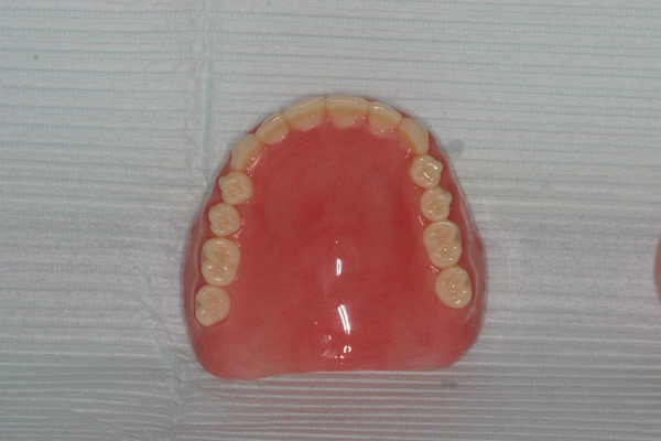 Complete maxillary denture -upper denture