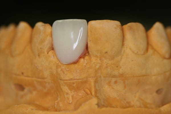 Interim partial denture flipper on dental mold