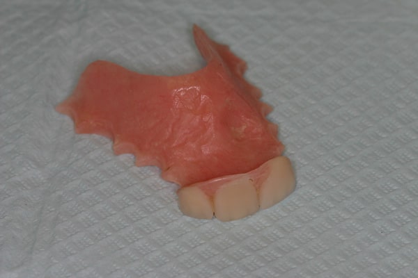 Interim partial denture flipper for three incisor teeth