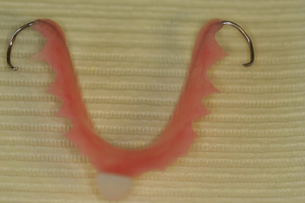 Interim partial denture flipper for front incisor