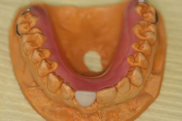 Interim partial denture flipper for front incisor on dental mold
