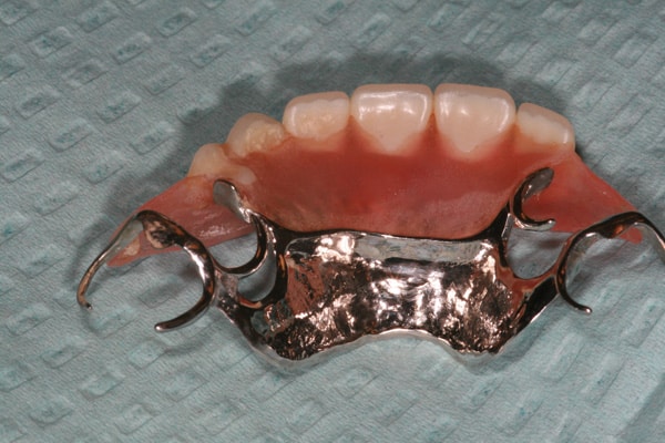 Removable partial denture for incisors and canines