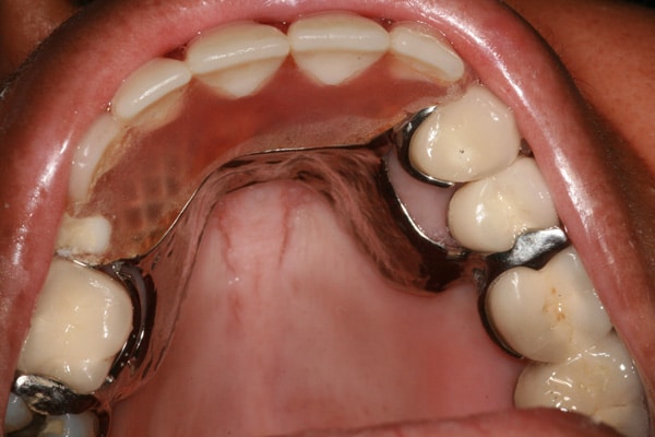 Upper removable partial denture in mouth
