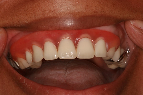 Upper removable partial denture in mouth