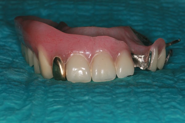Removable partial denture with gold tooth