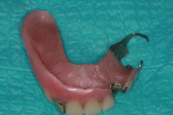 Partial Denture | Advanced Dentistry & Dental Implant Center