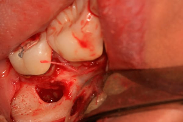 Oral Surgery | Advanced Dentistry & Dental Implant Center