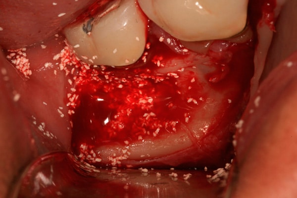 oral surgery | Advanced Dentistry & Dental Implant Center