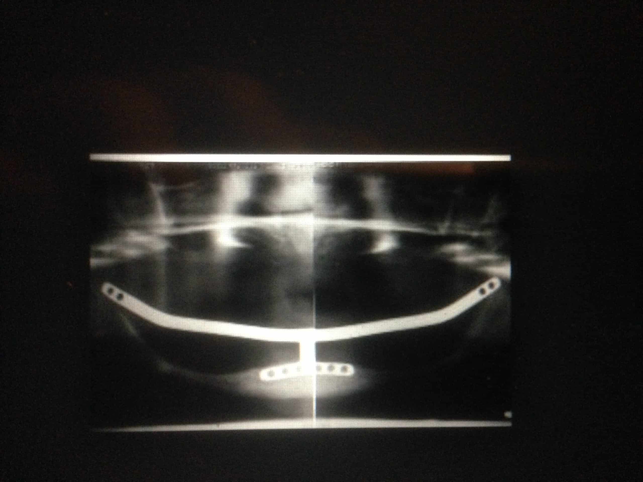 Ramus Frame - Advanced Dentistry & Dental Implant Center