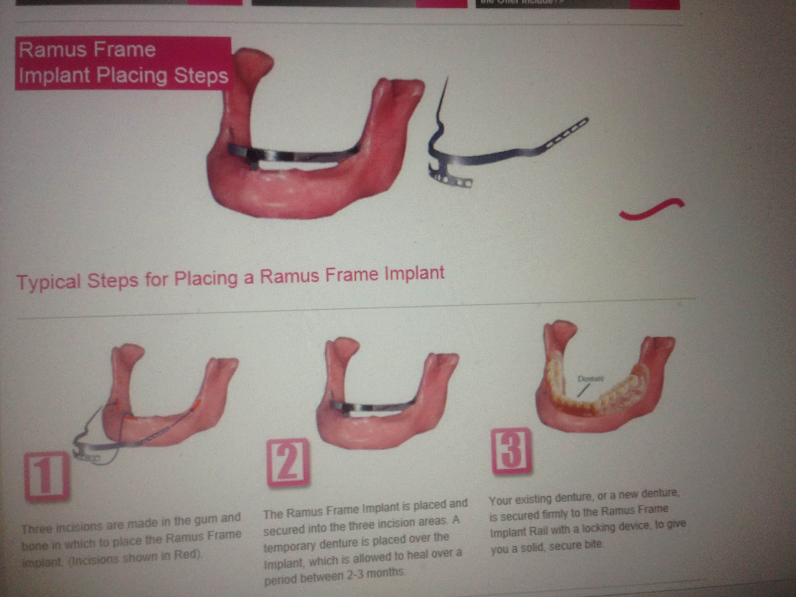 Ramus Frame Advanced Dentistry & Dental Implant Center