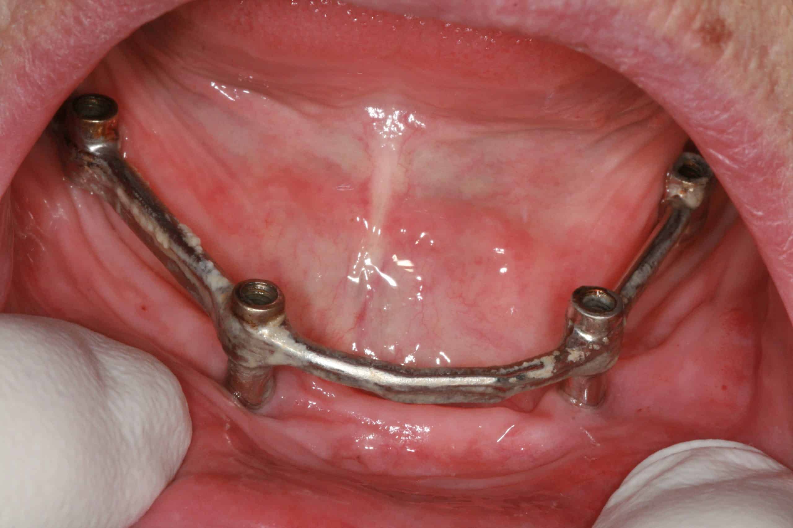 OLD Subperiosteal Mandibular Hybrid Maintenance Advanced Dentistry