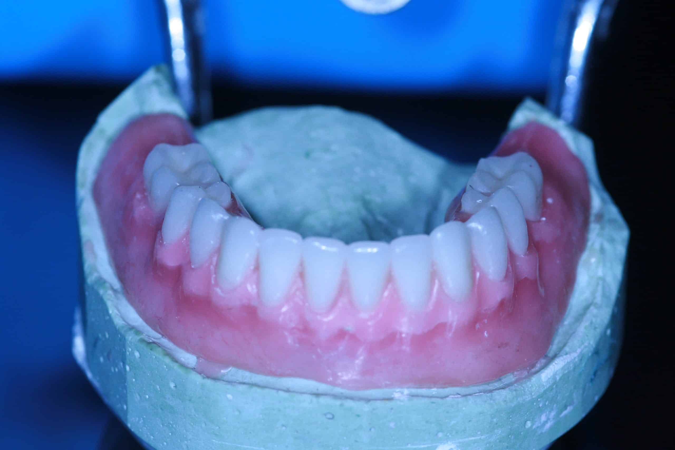 Implant Overdenture - Advanced Dentistry & Dental Implant Center