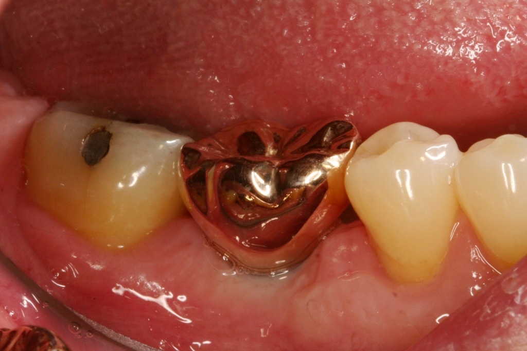 Gold Crowns Advanced Dentistry Dental Implant Center