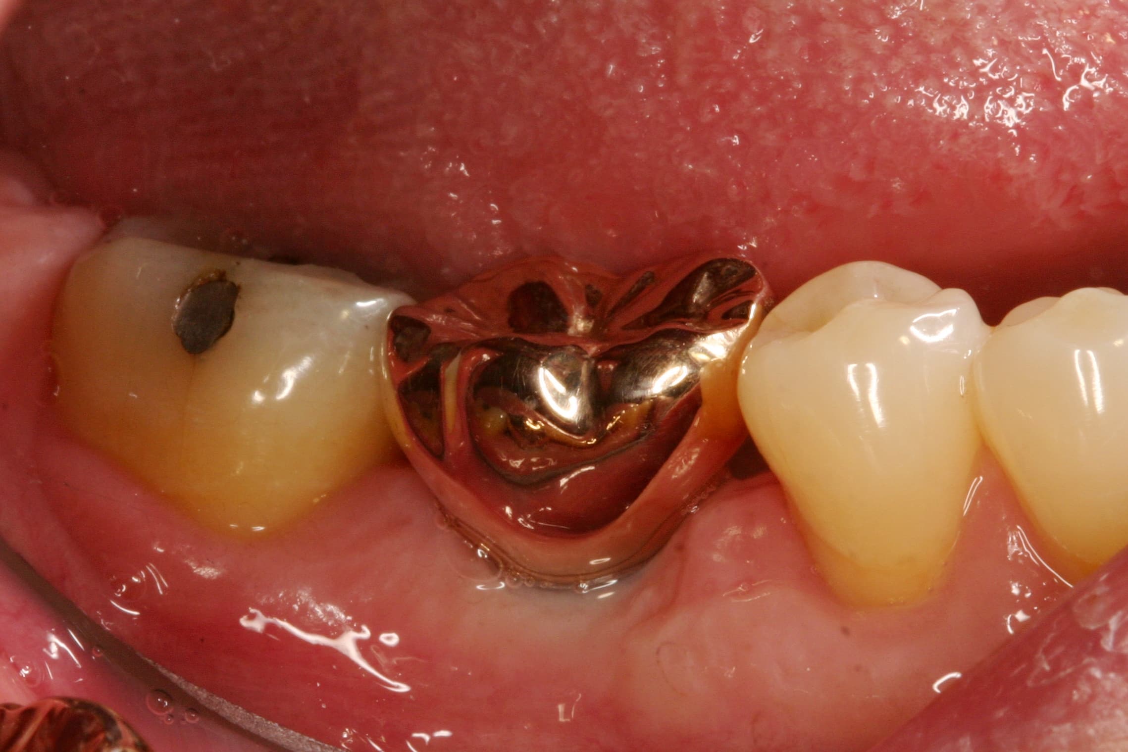 Gold Crowns For Your Teeth Pros Cons And Costs ZYEL Gold Crowns For Your Teeth Pros Cons And Costs ZYEL