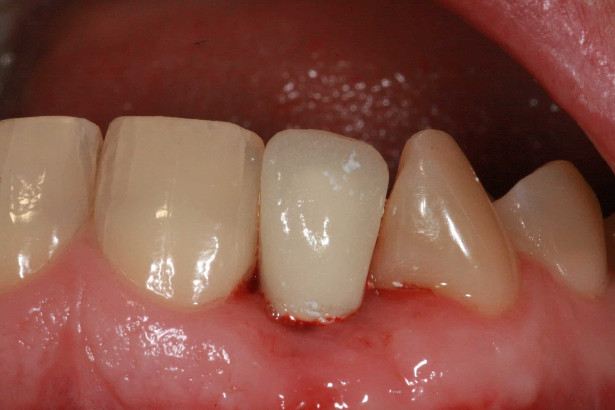 Seat Abutment & Cemented Temporary - Advanced Dentistry & Dental ...