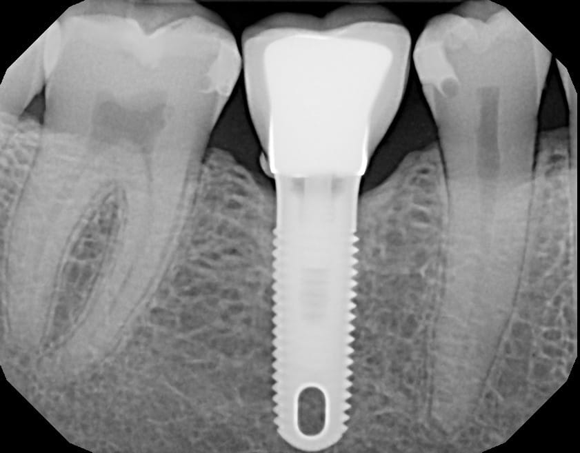 Crown Cement Below Gums Advanced Dentistry & Dental Implant Center