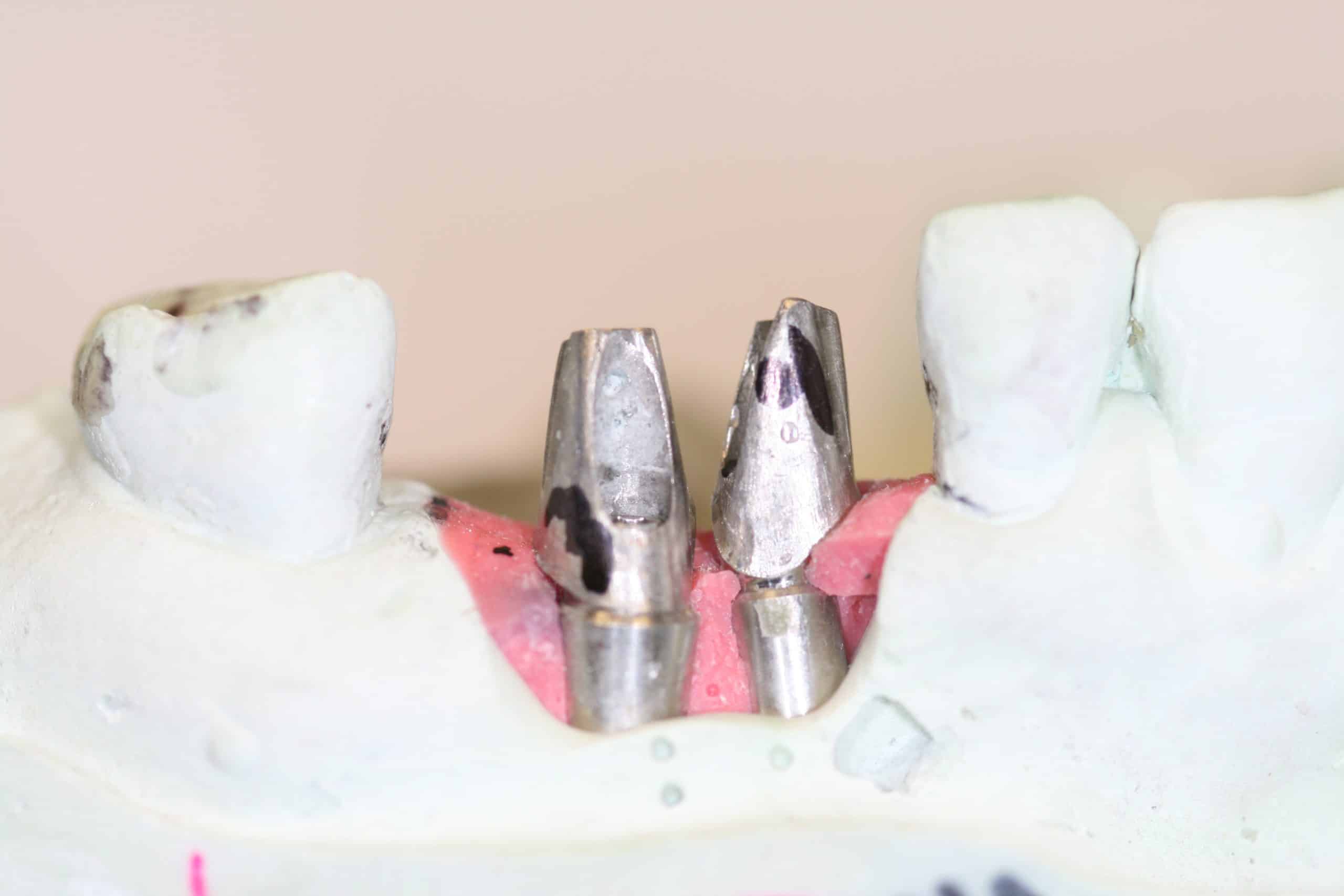 Poor Implant Positioning (not my case) Advanced Dentistry & Dental