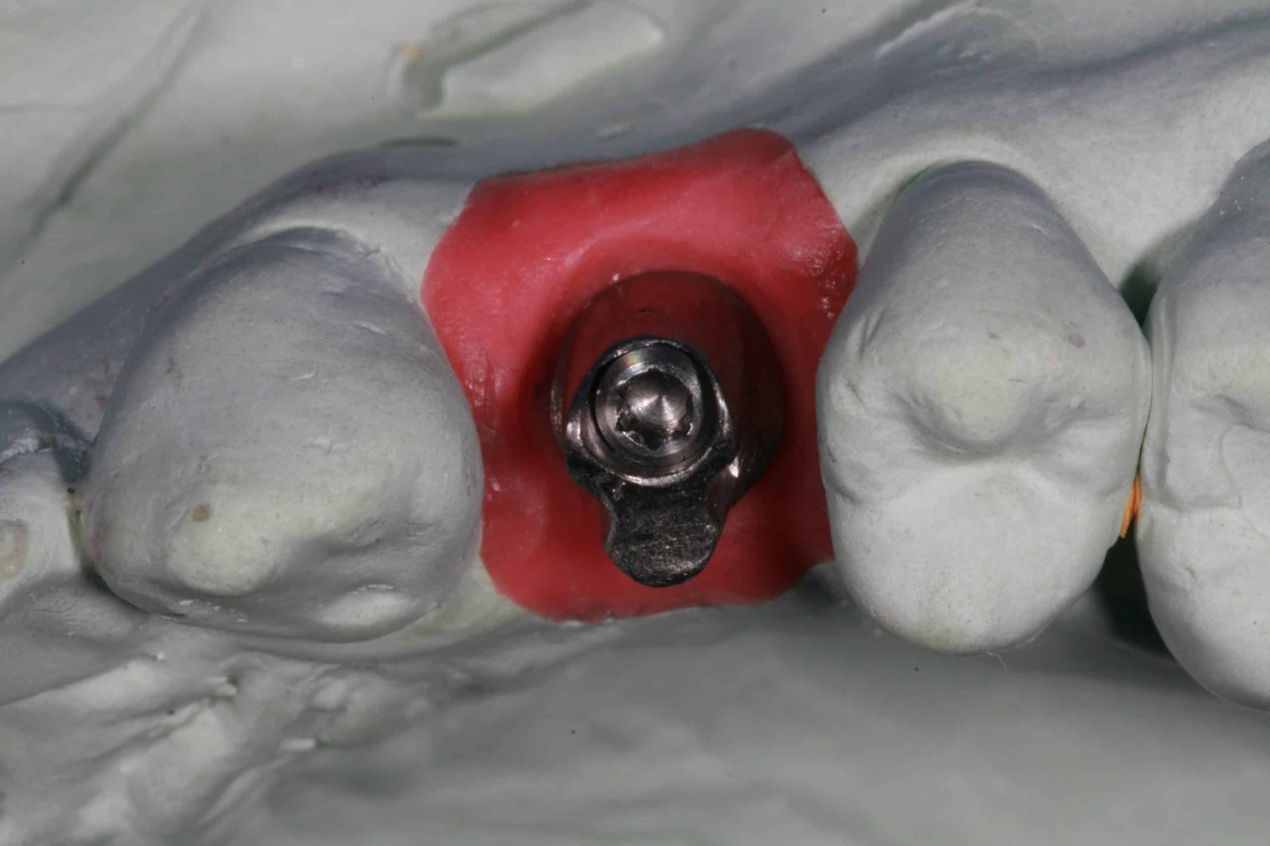 UCLA Custom Abutment Advanced Dentistry & Dental Implant Center