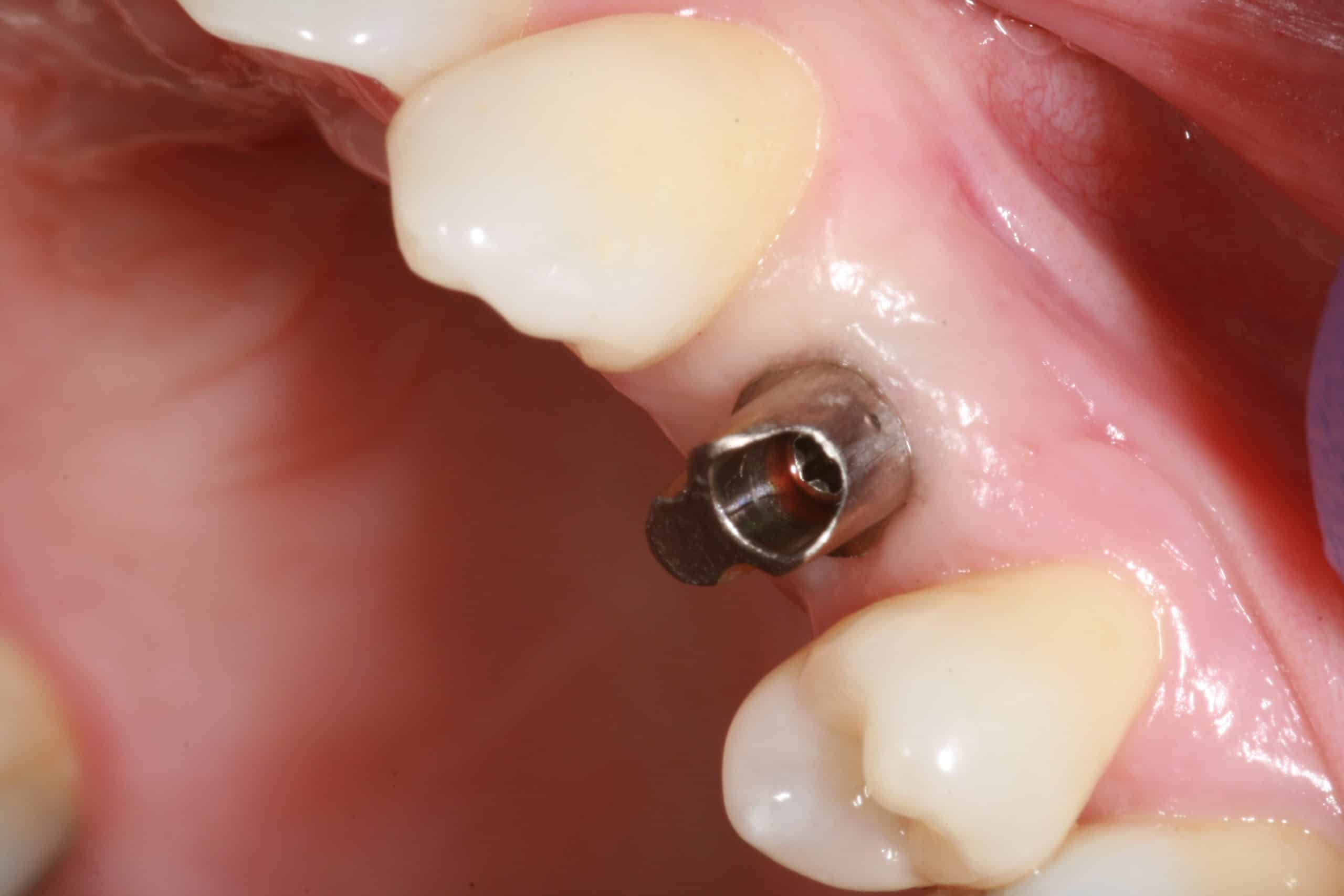 UCLA Custom Abutment Advanced Dentistry & Dental Implant Center