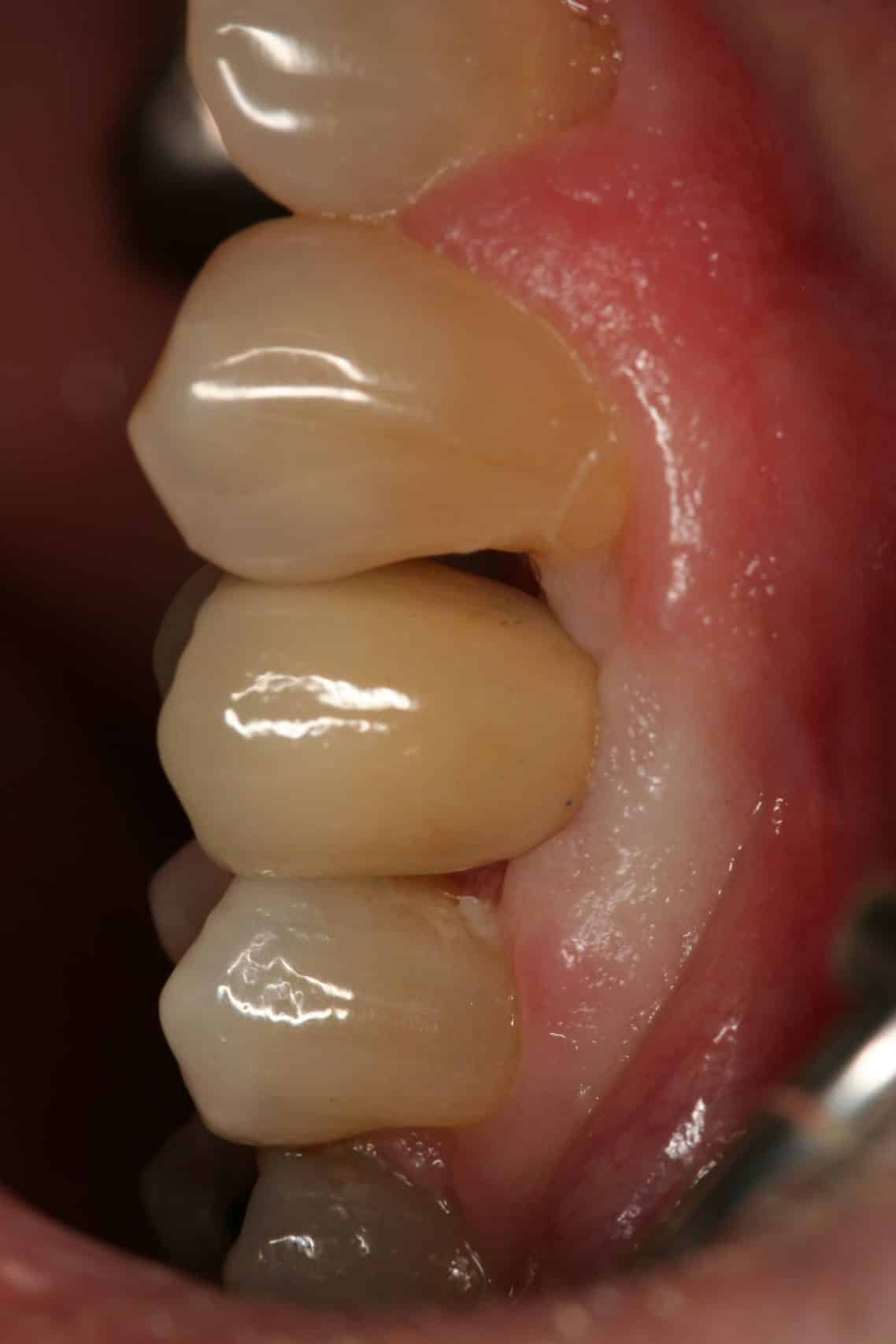 Atlantis Abutment & Procera Crown Advanced Dentistry & Dental Implant