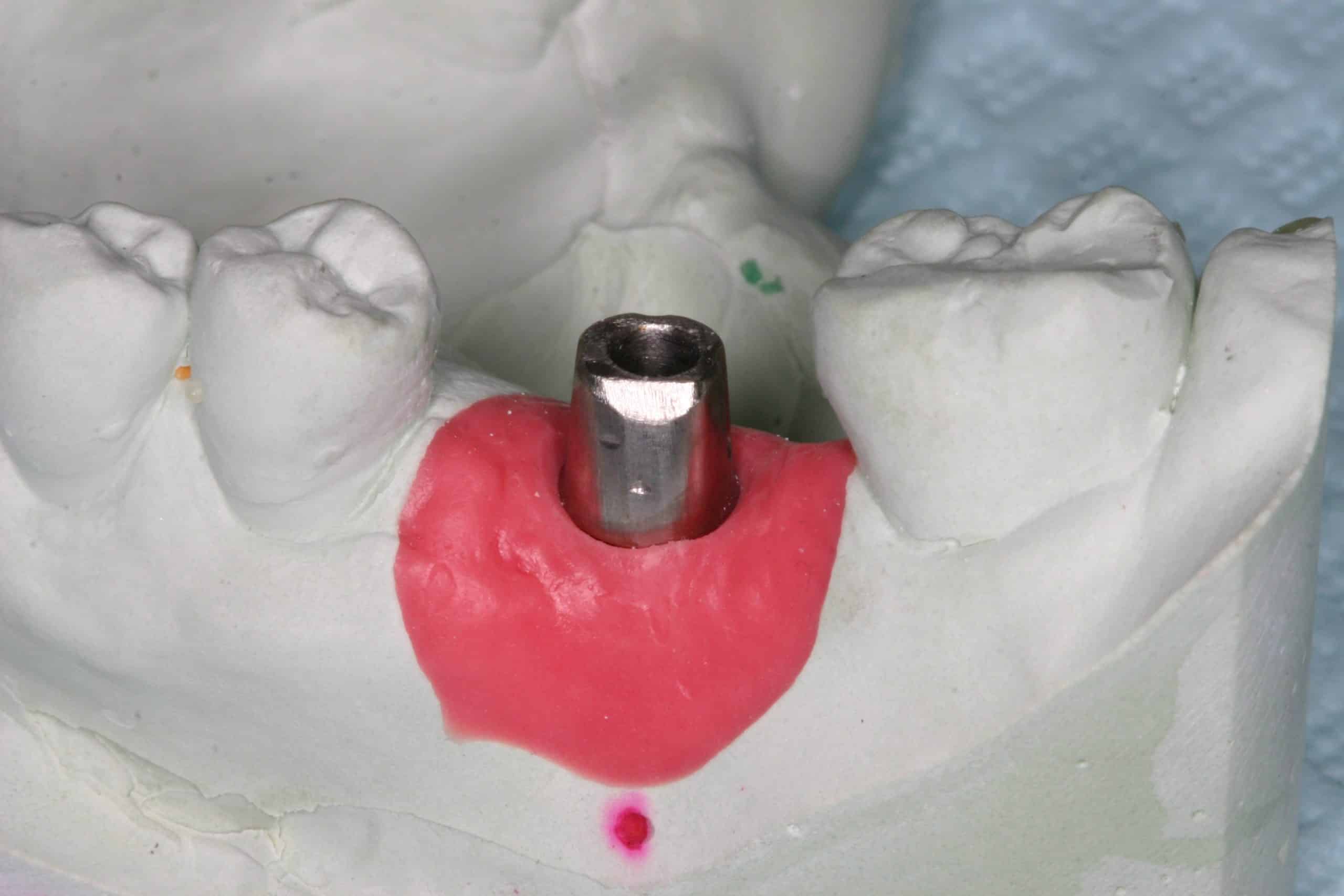 Gold Crown Advanced Dentistry & Dental Implant Center