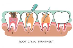 Root Canal; When Do I Need One