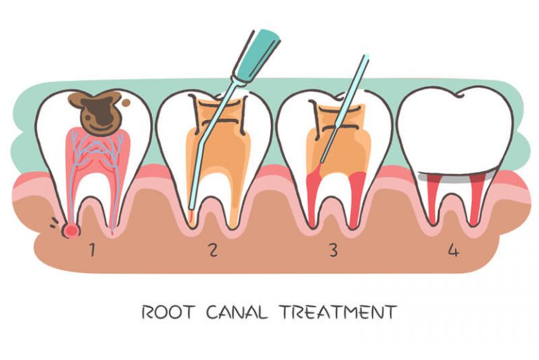 Root Canals Advanced Dentistry & Dental Implant Center