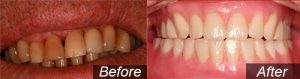 All on four Dental Implants in Mansfield, OH