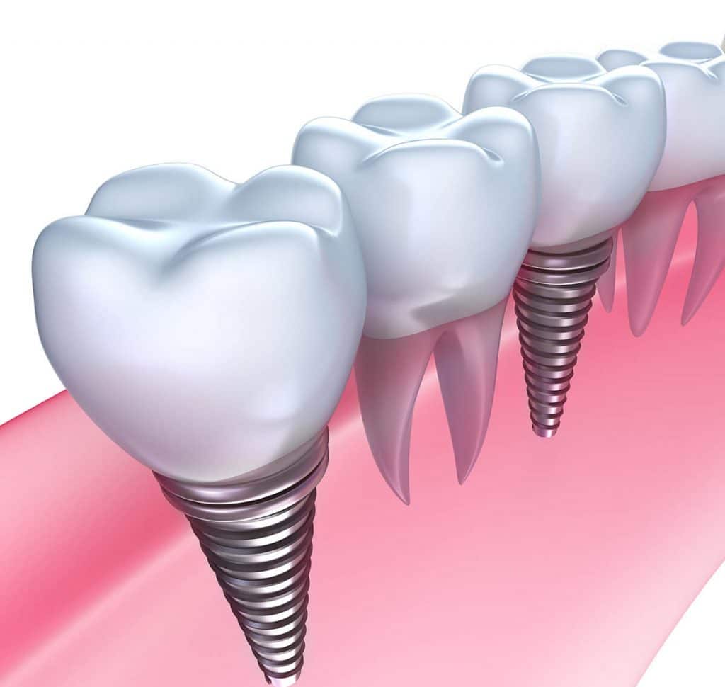 Are Dental Implants Safe? Risks and Problems Involved Advanced