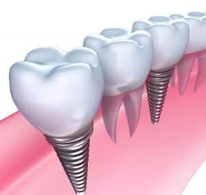 Are Dental Implants safe?