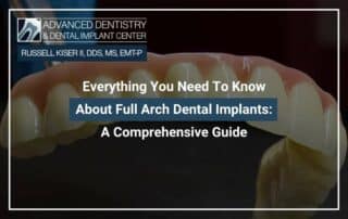 Everything You Need To Know About Full Arch Dental Implants: A Comprehensive Guide