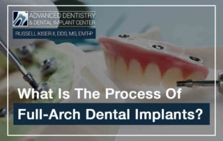 What Is The Process Of Full Arch Dental Implants?