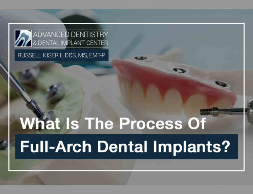 What Is The Process Of Full-Arch Dental Implants