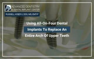 Using All-On-Four Dental Implants To Replace An Entire Arch Of Upper Teeth