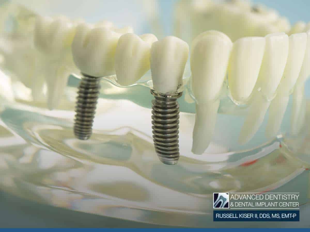 All-On-Four Dental Implants model showing implant-supported teeth.