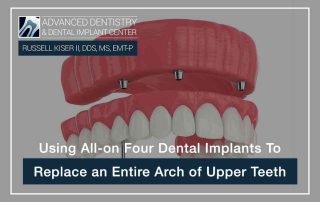 Using All-on Four Dental Implants To Replace an Entire Arch of Upper Teeth