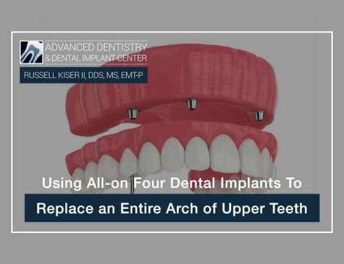 Using All-On Four Dental Implants To Replace An Entire Arch Of Upper Teeth