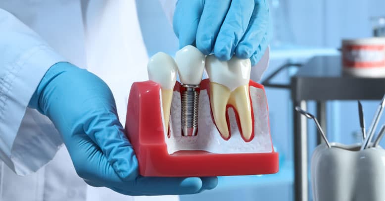 Model of Dental Implant And Teeth With Exposed Roots
